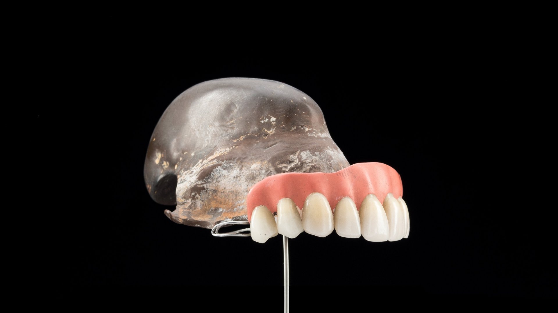 Obturator prosthesis with palate for defect closure (made of rubber)