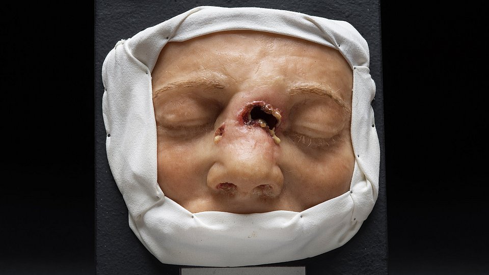 Wax model of a face between forehead and upper lip, surrounded by white cloth, with the deformations of a syphilis infection seen on the bridge of the nose