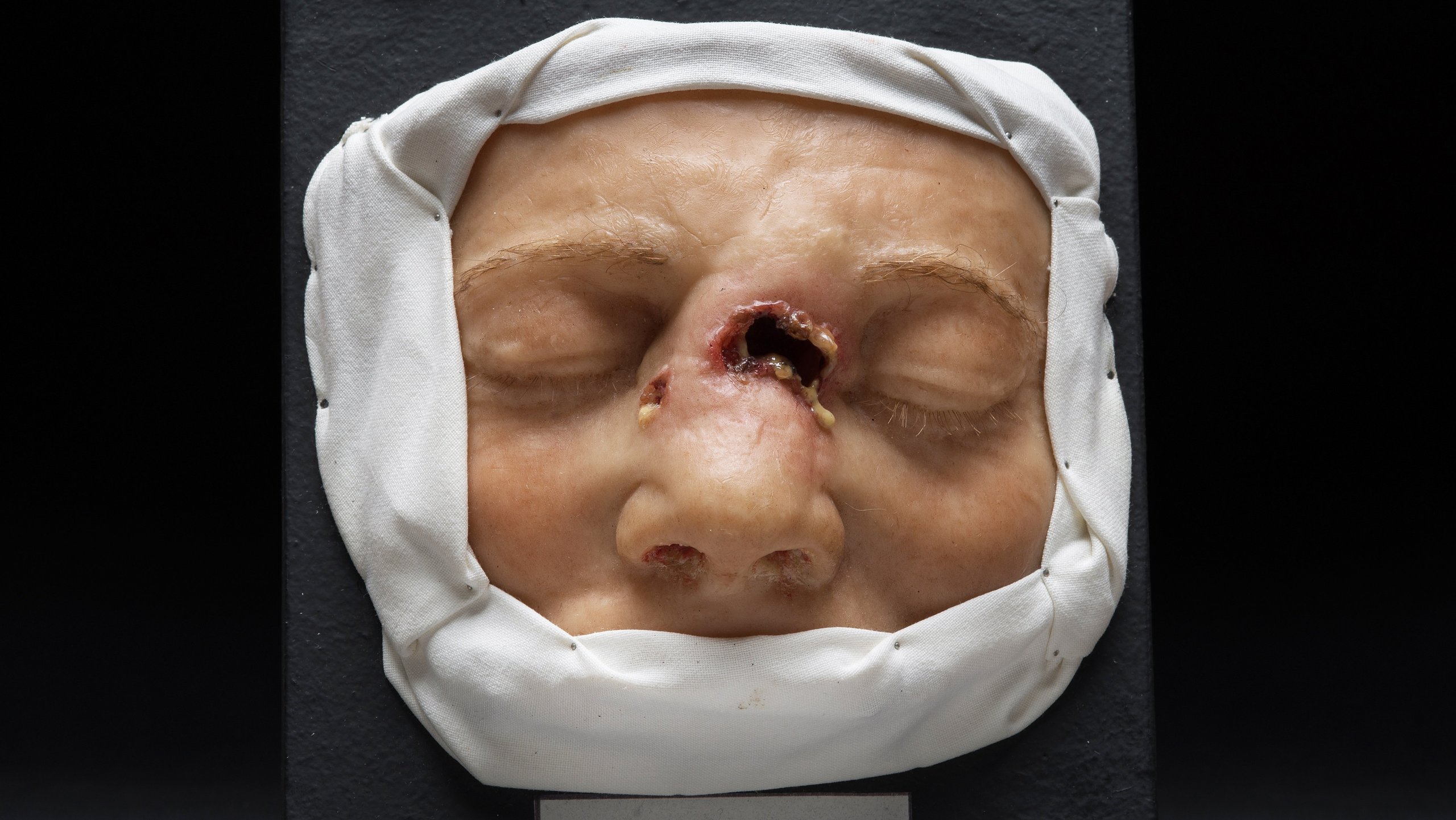 Wax model of a face between forehead and upper lip, surrounded by white cloth, with the deformations of a syphilis infection seen on the bridge of the nose