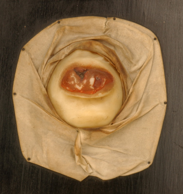Zerfallene Gummata der Zunge beim tertiären Stadium der Lues
