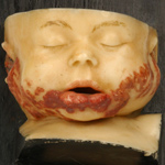 Wachsmoulagen aus der zahnärztlichen Sammlung